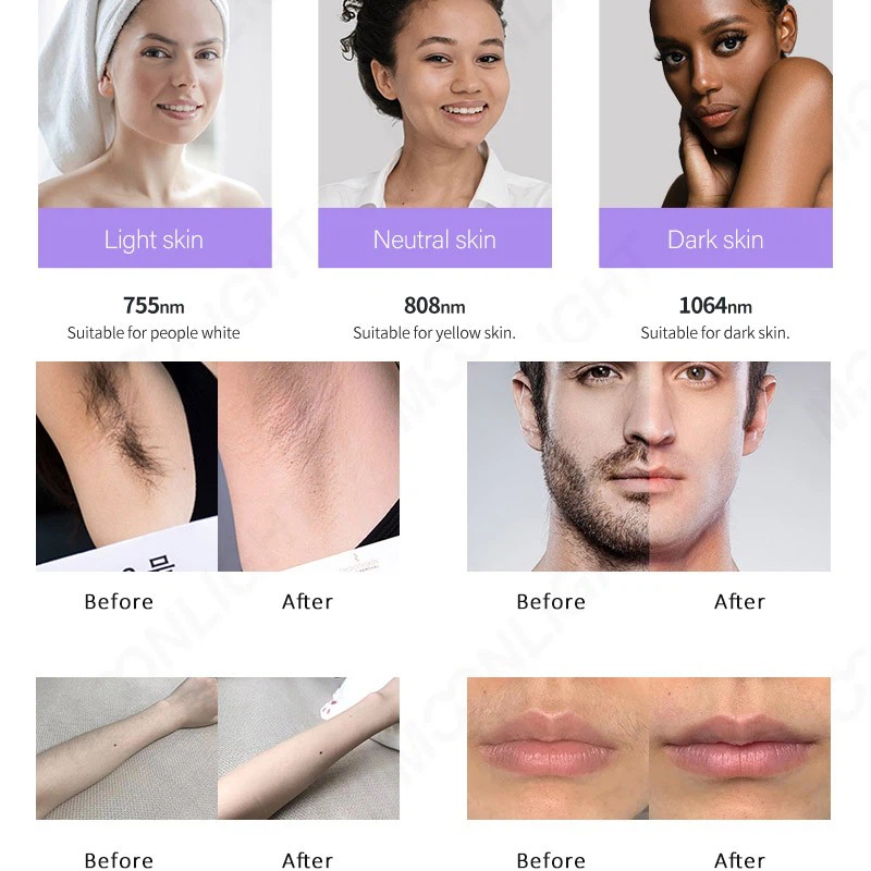 AI Intelligent System Hair Removal Machine